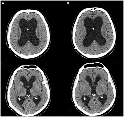 Subcutaneous foslevodopa in akinetic crisis. A case report from the neurological intensive care unit